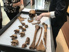 This skeleton, possibly of John Barber, is being studied at the National Museum of Health and Medicine. Barber, once believed to be a vampire, most likely had tuberculosis.