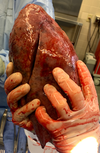 One of the patient’s vape-damaged lungs.