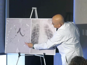 Dr. Hassan Nemeh of Detroit’s Henry Ford hospital points to an image of the transplant patient's damaged lungs on the left, beside an image of typical healthy lungs.