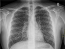 This chest X-ray of a 17-year-old Ontario boy was taken two days after he was hospitalized with a vaping-related lung injury.