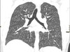 This CT chest image shows “tree-in-bud” signs of “popcorn lung” throughout both lungs, causing airway obstruction.
