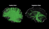Images of “healthy” vs. “vegetative brains.”