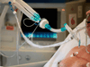 A tube from a ventilator on a sedated patient infected with COVID-19 at the intensive care unit of the Peupliers private hospital in Paris, April 7, 2020.