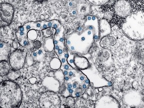 This 2020 electron microscope image made available by the U.S. Centers for Disease Control and Prevention shows the spherical particles of the new coronavirus, colorized blue, from the first U.S. case of COVID-19.