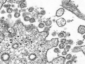 This 2020 electron microscope made available by the U.S. Centers for Disease Control and Prevention image shows the spherical coronavirus particles from the first U.S. case of COVID-19. Health officials are reporting more COVID-19 cases linked to an outbreak in southern Saskatchewan as the province announced guidelines for students returning to school in September.