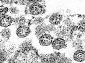 This 2020 electron microscope made available by the U.S. Centers for Disease Control and Prevention image shows the spherical coronavirus particles from the first U.S. case of COVID-19.