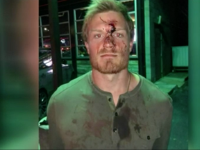 Conner Capel as seen after the fight in a photo provided by his lawyer to a Houston television station.