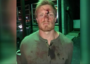 Conner Capel as seen after the fight in a photo provided by his lawyer to a Houston television station.