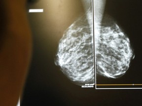 A doctor exams mammograms, a special type of X-ray of the breasts, which is used to detect tumours, in this file photo.