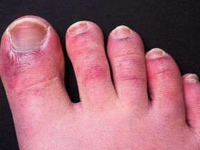 "COVID toe" looks like chilblains, which happen as a result of exposure to cold.
