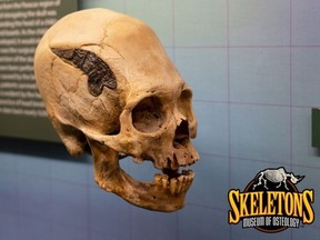 The 2,000-year-old skull is believed to be of a warrior who sustained a serious skull fracture in battle and had surgery to  embed a piece of metal to mend the fracture.