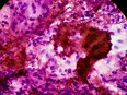 FNAC of lymph nodes tissue Cytology microscopic 100x show Microbacterium Tuberculosis TB. Lymph node TB at medical histopathology laboratory.