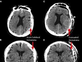A and B show CT scans demonstrating the patient's bilateral acute subdural hematoma with a larger mass effect on the left side prior to surgery. C and D show same scan sequences after decompressive craniotomy demonstrating evacuation of the left subdural hematoma.
