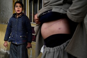 In this photo taken on Feb. 4, 2022, Nooruddin, who sold his kidney to raise money for his family, shows the scars from the operation, next to his son Javid at their house in the Khwaja Koza Gar area in Herat.