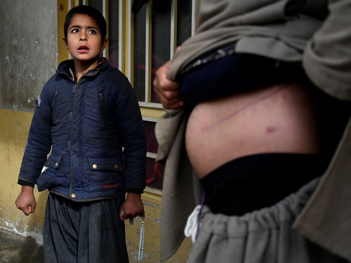  In this photo taken on Feb. 4, 2022, Nooruddin, who sold his kidney to raise money for his family, shows the scars from the operation, next to his son Javid at their house in the Khwaja Koza Gar area in Herat.
