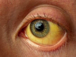 yellow staining of the sclera of the eye in diseases of the liver, cirrhosis, hepatitis, bilirubin