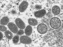 Monkeypox, gezeigt in einem elektronenmikroskopischen Bild, ist eine Viruserkrankung, die mit Pocken verwandt ist, aber weniger ansteckend und weniger tödlich ist.