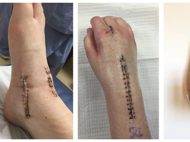 Rachel Gehue arthiritis surgery