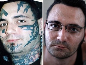 Former skinhead Bryon Widner removed multiple racist tattoos from his face.