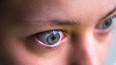 Macro closeup profile portrait of young woman face with Grave's disease hyperthyroidism symptoms of ophthalmopathy bulging eyes and proptosis edema