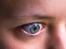 Macro closeup profile portrait of young woman face with Grave's disease hyperthyroidism symptoms of ophthalmopathy bulging eyes and proptosis edema