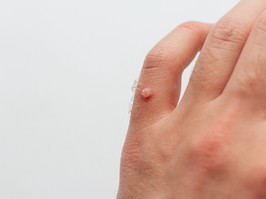 wart on hand, skin problem