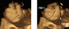 An example of a cry-face gestalt of a kale-exposed fetus, right, and the baseline expression, left. FM11 = nasolabial furrow; FM16 = lower-lip depressor
