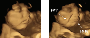 Kaleye maruz kalmış bir fetüsün ağlayan suratlı bir gestalt örneği, sağda ve taban çizgisi ifadesi, solda.  FM11 = nazolabial oluk;  FM16 = alt dudak bastırıcı