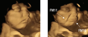 Ein Beispiel für eine Schreigesichtsgestalt eines Grünkohl-exponierten Fötus, rechts, und der Grundausdruck, links.  FM11 = Nasolabialfurche;  FM16 = Unterlippenspatel