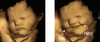 An example of a laughter-face gestalt, right, of a carrot-exposed fetus and the baseline expression, left. FM6 = cheek raiser; FM12 = lip-corner puller.