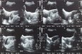 Ultrasound image of lower abdomen, ovary and uterus with tumor or uterine fibroid, leiomyoma of female woman patient for gynecological medical exam, analysis and test
