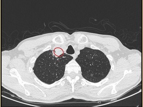 A CT scan demonstrated the presence of a right paratracheal abscess.
