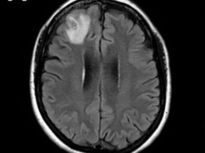 Scan of live worm inside woman's brain
