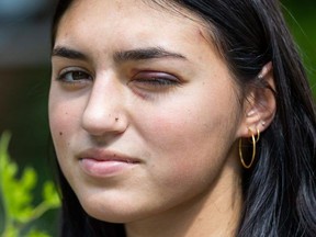Western University student Kali MacDonald can't see out of her left eye after she was struck by a BB while standing with friends on Broughdale Avenue on Sept. 5. Photo shot on Monday, Sept. 11, 2023. (Derek Ruttan/London Free Press)