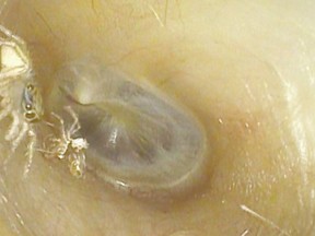 A spider and its exoskeleton in the ear canal