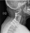 An X-ray shows how surgeons rebuilt vertebrae in Zena’s neck.