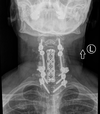 X-ray shows how surgeons rebuilt vertebrae in neck.