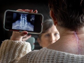 A woman holds an MRI image while a large surgical scar is seen on the back of her neck.