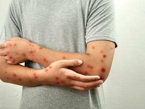 A person with measles.