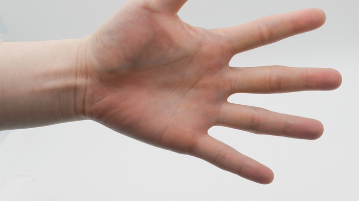 Quebec man has two fingers amputated to cure body integrity dysphoria