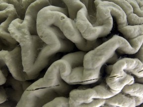 A section of a human brain with Alzheimer's disease.