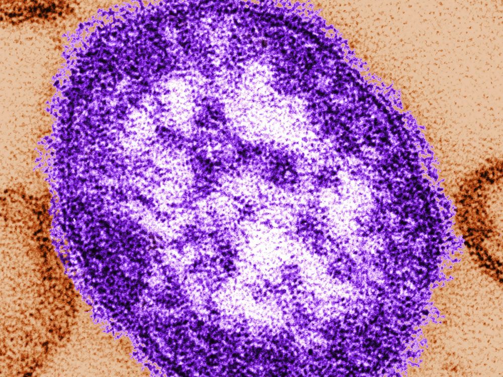 NextImg:Child under 5 dies after being hospitalized for measles: Public Health Ontario