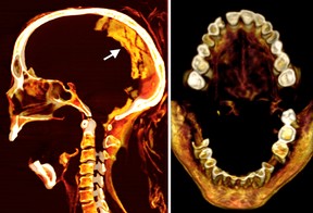 Scans of the the Screaming Woman Mummy's head.