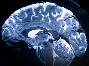 NS, NB politicians call for federal inquiry into strange brain disease NS, NB politicians call for federal inquiry into strange brain disease