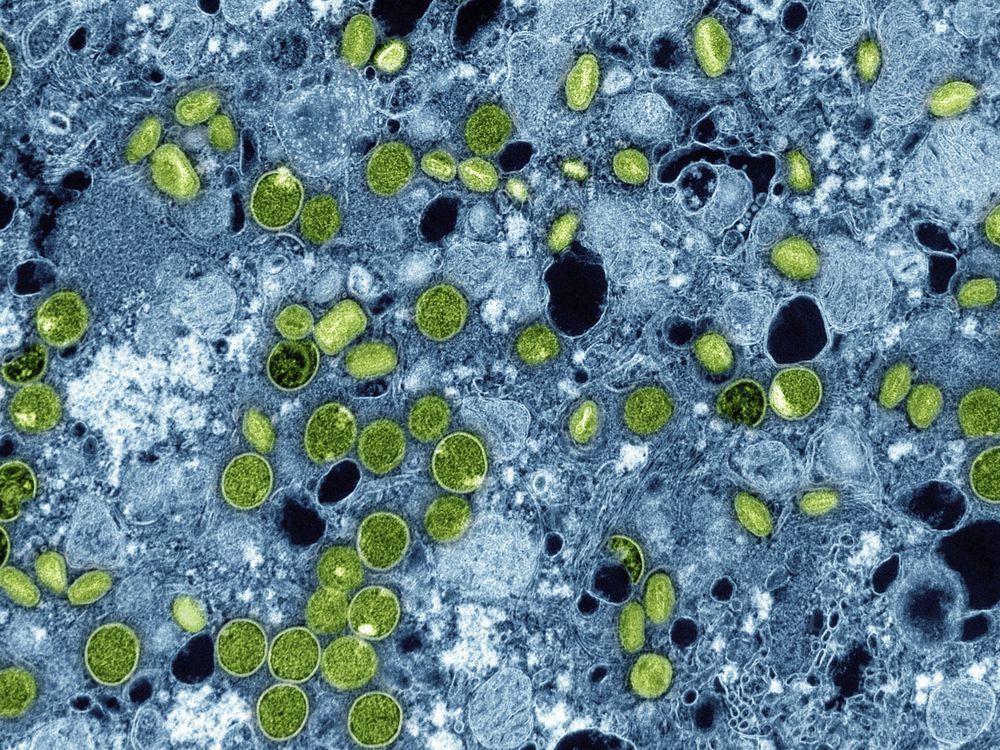 NextImg:First Canadian case of more severe mpox strain confirmed in Manitoba