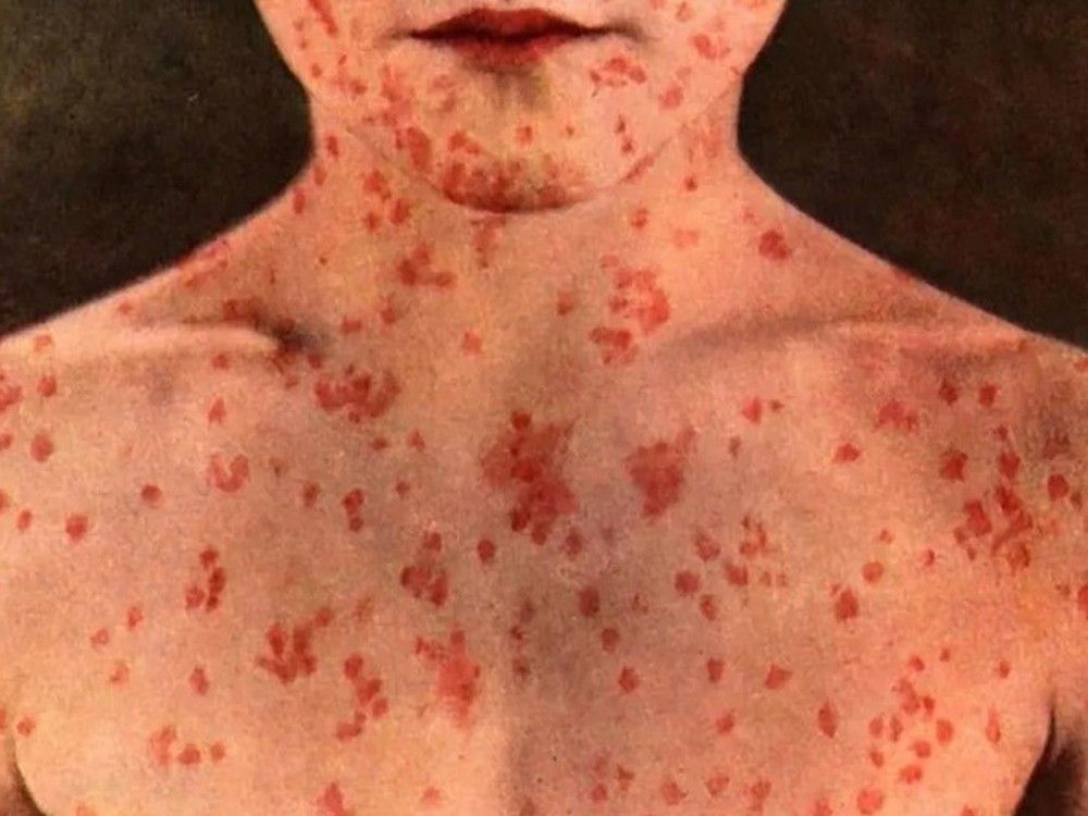 NextImg:Coca-Cola Coliseum concertgoers exposed to measles: Toronto Public Health