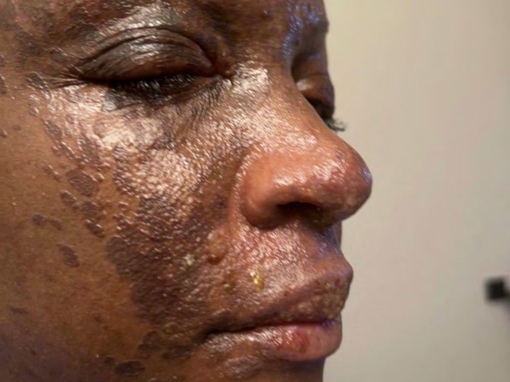  Renita Francois says she was severely burned moments after lighting a candle in January 2023, according to a lawsuit.