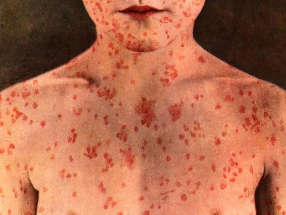 The province reported Friday that there are now 1,656 measles cases in Alberta.