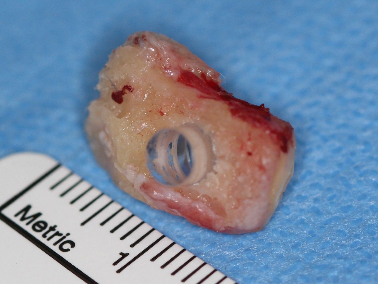  A piece of tooth containing a plastic lens used in a tooth-in-eye surgery, formally known as Osteo-odonto-keratoprosthesis operation, performed by Dr. Greg Moloney and other surgeons.