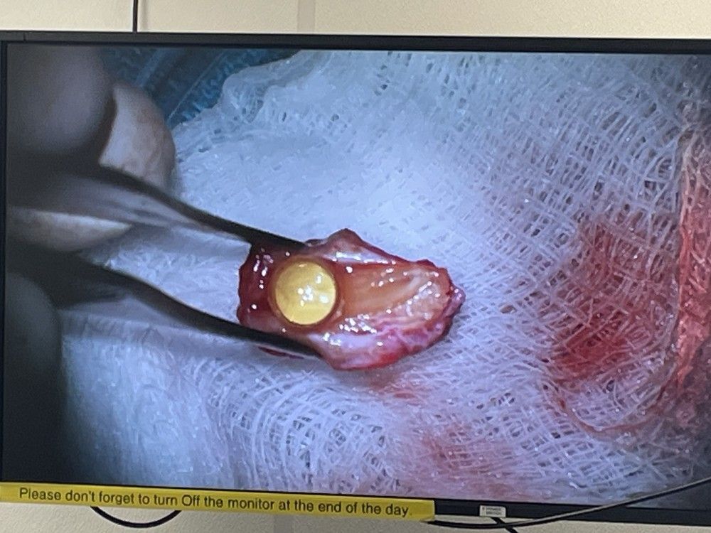  Gail Lane’s tooth, with a lens inserted inside, after it was embedded in her cheek for three months and before it was inserted into her eye in May.
